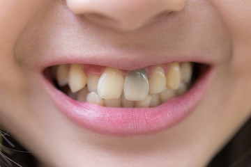 Dead tooth ,teeth discoloration ,teeth change color,