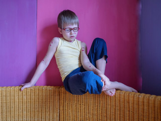 Blond child in glasses has chickenpox. Mother smeared follicles with Takkelani pink solution all...