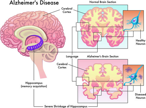 Medical illustration of Alzheimer`s disease isolated on white.