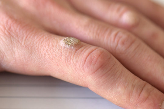 Wart on the hand finger. 