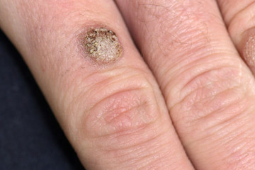 Wart on the hand finger. 