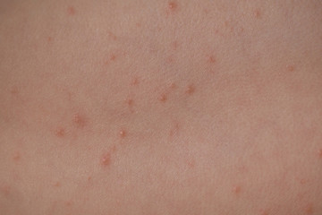 Large spots and pimples acne on the body are sweating. Viral eczema, chicken pox or rubella, reaction to enterovirus.