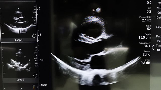 Ultrasound imaging or sonography used in medicine show how heart works. image of heart on modern ultrasound monitor. Ultrasonography machine. High technology medical and healthcare equipment