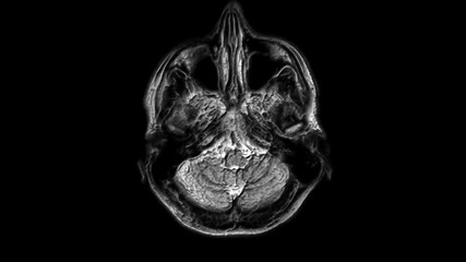 Voluminous MRI scans of the brain and head to detect tumors. Diagnostic medical tool