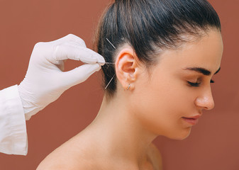 Acupuncturist treats a patient’s illness with acupuncture at special points on her ear. Acupuncture - alternative medicine - obrazy, fototapety, plakaty