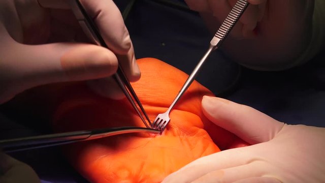 Hand surgeons perform a wide variety of operations such as fracture repairs, releases, transfer and repairs of tendons and reconstruction of injuries, rheumatoid deformities and congenital defects.
