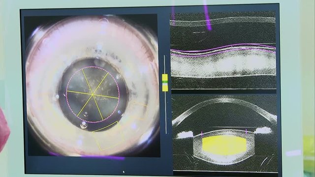 Eye surgery with laser beam