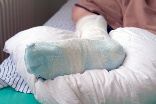 broken leg is fixed and lies on the bed. Young male leg in a cast lies on a bed in a hospital.
