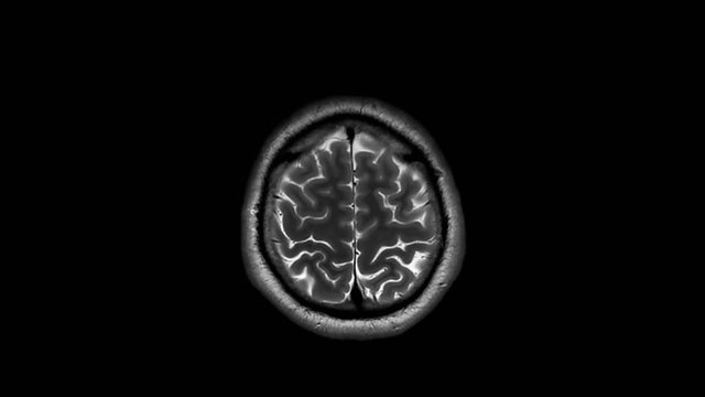 Magnetic Resonance Imaging (MRI) of the Human Brain, 3Tesla sagittal T2 weighted sequences real scan