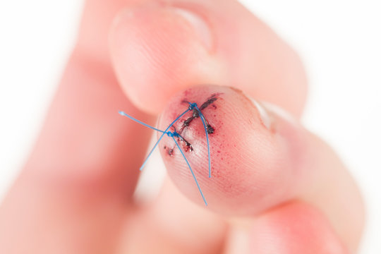 A deep wound is sewn on the middle finger of the hand