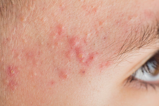 Pimples as a problem in an adolescent teenage boy 13-14 years old
