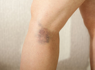 Dark blue, black bruise on the back of the female leg as a result of a ruptured vessel. A vein burst on the leg. Tissue injury