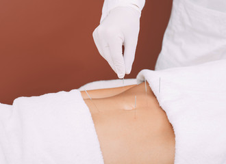 Acupuncture of a woman's abdomen to remove abdominal pain. Acupuncture needles close up