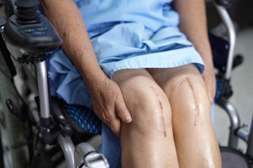 Obraz premium Asian senior or elderly old lady woman patient show her scars surgical total knee joint replacement Suture wound surgery arthroplasty on wheelchair in nursing hospital ward.