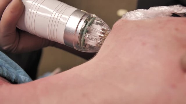 Close-up. microneedle RF lifting procedure. Hardware cosmetology. Beautician conducts a facial rejuvenation procedure for a bald woman.