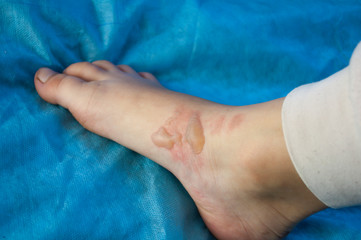 blisters on a child's foot from scalding