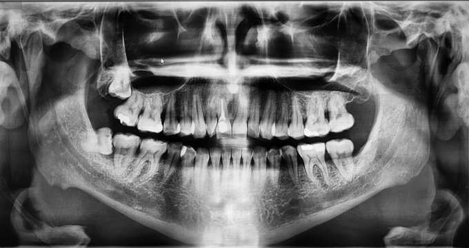Image tooth x-ray in computer.Panoramic radiograph showed multiple bony wisdom teeth both side of mandible and maxilla jaw bone.Dental treatment concept.
