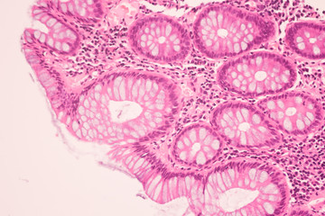 View in microscopic of ductal cell carcinoma, adenonocarcinoma from human breast cancer, tissue...