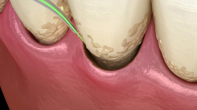 Laser removes a thin layer of infected skinm, teeth cleaning.  Medically accurate tooth 3D animation