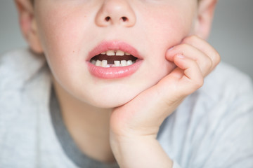 Teenager child with a tooth dropped out