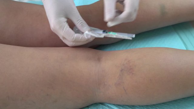 doctor's hands open a syringe before injection. sclerotherapy.