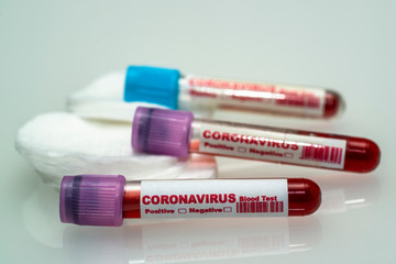 Coronavirus blood test .  Coronavirus positive blood in laboratory. 2019-nCoV Coronavirus originating in Wuhan, China