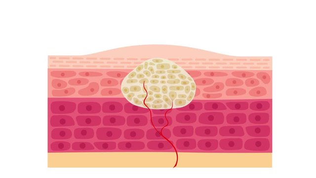 wart treatment . remove it from skin by surgery vector callus graphic animation