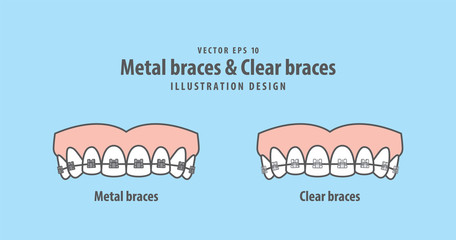 Metal braces teeth & Clear braces teeth (Upper) illustration vector on blue background. Dental concept.