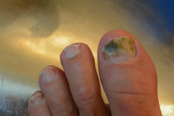 Fungus Infection on Nails of Man's Foot