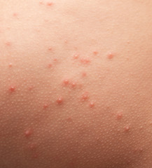 allergic rash on children's skin
