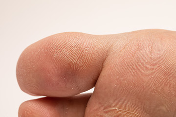 Calluses and thick, dehydrated skin under the big toe of a female foot