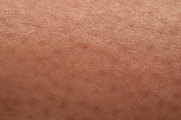 Orange peel woman skin close up, cellulite caused by water retention