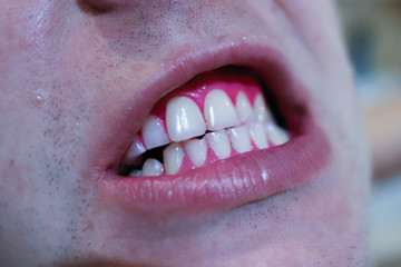 Obraz premium Close up studio shot isolated on grey background african guy pointing finger to white shiny toothy smile, concept of teeth whitening, dental care, dentistry services and products advertisement concept