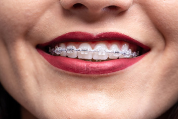 Naklejka premium Kissable lips, white teeth, and braces