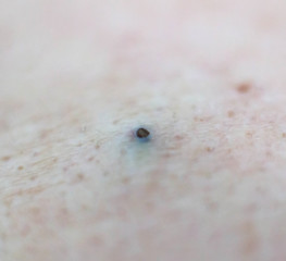 Black pimple acne on human skin, background. Acne and acne treatment, cosmetology, hygiene