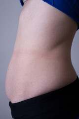 one of the stages of postpartum excess growth of adipose tissue and skin of the abdomen, after surgery during childbirth. Close-up belly of a girl with a postpartum belly