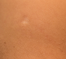 The scar from grafting on the body