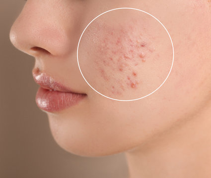 Teenage girl with acne problem on beige background, closeup