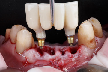 installation of a dental prosthesis on four teeth in the lower jaw