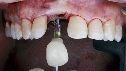 installation of a crown in the part of the central tooth of the upper jaw © Dental Pro Content