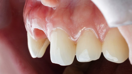 gum and lack of a central tooth before installing a crown