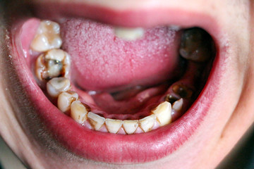 open mouth with broken, diseased teeth affected by caries and periodontitis. Steel pin in the gum for the installation of a dental crown. Smoker's teeth coated with nicotine plaque.