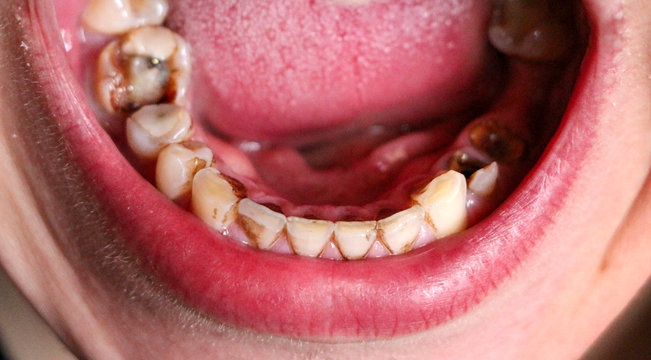 open mouth with broken, diseased teeth affected by caries and periodontitis. Steel pin in the gum for the installation of a dental crown. Smoker's teeth coated with nicotine plaque.