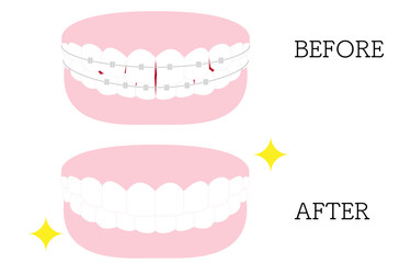 審美歯科、歯列矯正のイラスト：歪んだ歯並びと綺麗な歯並び、メタルブラケットつき