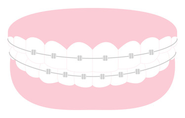 審美歯科、歯列矯正のイラスト：綺麗な歯並びとメタルブラケット