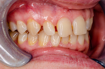 oberkiefer mit l&uuml;ckigem zahnbestand