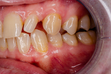 oberkiefer mit l&uuml;ckigem zahnbestand