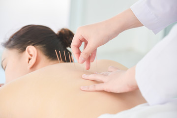 Fototapeta na wymiar Hands of therapist doing acupuncture at patient back ,Alternative medicine concept.