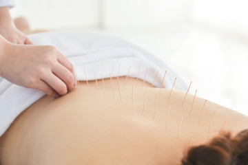 Row of needles at patient back who receiving accupuncture therapy,Alternative medicine concept. - obrazy, fototapety, plakaty