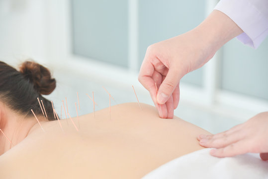 Hands of therapist doing acupuncture at patient back ,Alternative medicine concept.